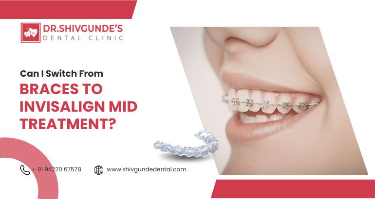 can i switch from braces to invisalign mid-treatment?