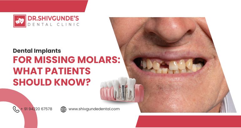 dental implants for missing molars: what patients should know?