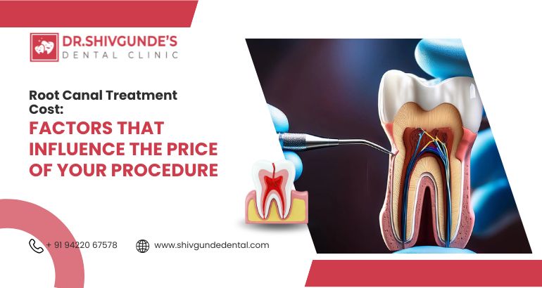 root canal treatment cost factors that influence the price of your procedure