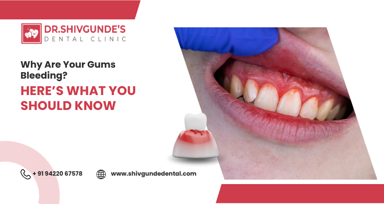 bleeding gum treatment